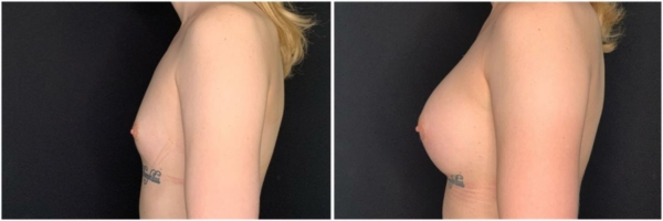 male-to-female-n-top-surgery-before-after-photo-los-angles-kk-1-3