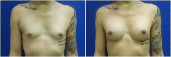 male-to-female-n-top-surgery-before-after-photo-los-angles-rb-1-1