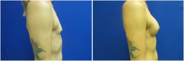 male-to-female-n-top-surgery-before-after-photo-los-angles-rb-1-2