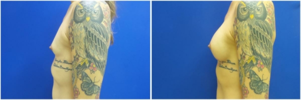 male-to-female-n-top-surgery-before-after-photo-los-angles-rb-1-3