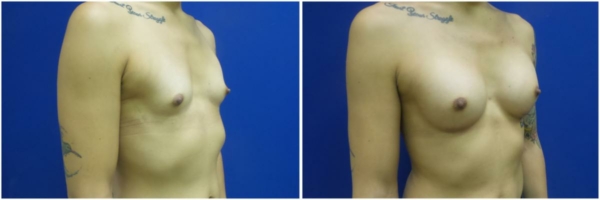 male-to-female-n-top-surgery-before-after-photo-los-angles-rb-1-4