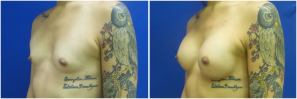 male-to-female-n-top-surgery-before-after-photo-los-angles-rb-1-5