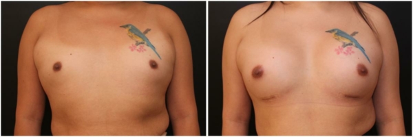 male-to-female-n-top-surgery-before-after-photo-los-angles-vl-1-1