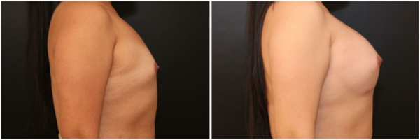 male-to-female-n-top-surgery-before-after-photo-los-angles-vl-1-2
