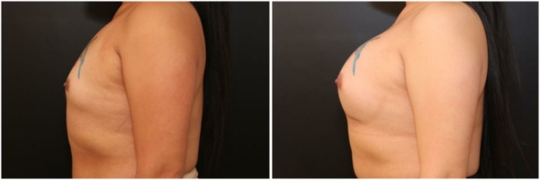 male-to-female-n-top-surgery-before-after-photo-los-angles-vl-1-3