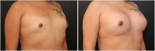 male-to-female-n-top-surgery-before-after-photo-los-angles-vl-1-4