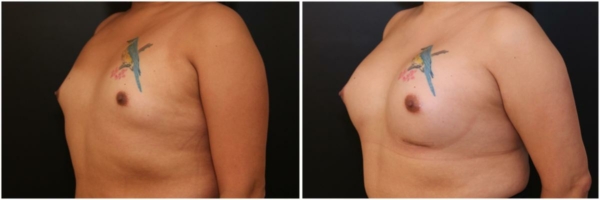 male-to-female-n-top-surgery-before-after-photo-los-angles-vl-1-5